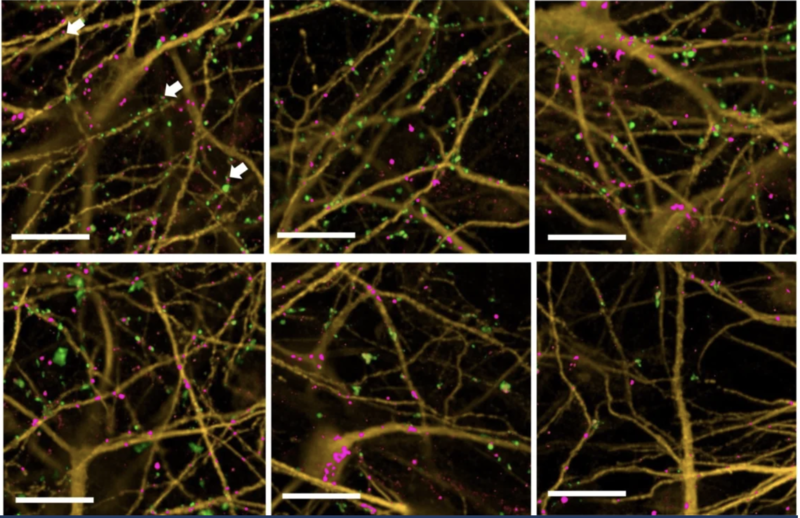 Synapses, shown as green and pink dots, represent points of communication between neurons, grown here in the laboratory from stem cells. The study found that neuronal cultures from some Alzheimer’s patients were more resilient to synapse loss after exposu